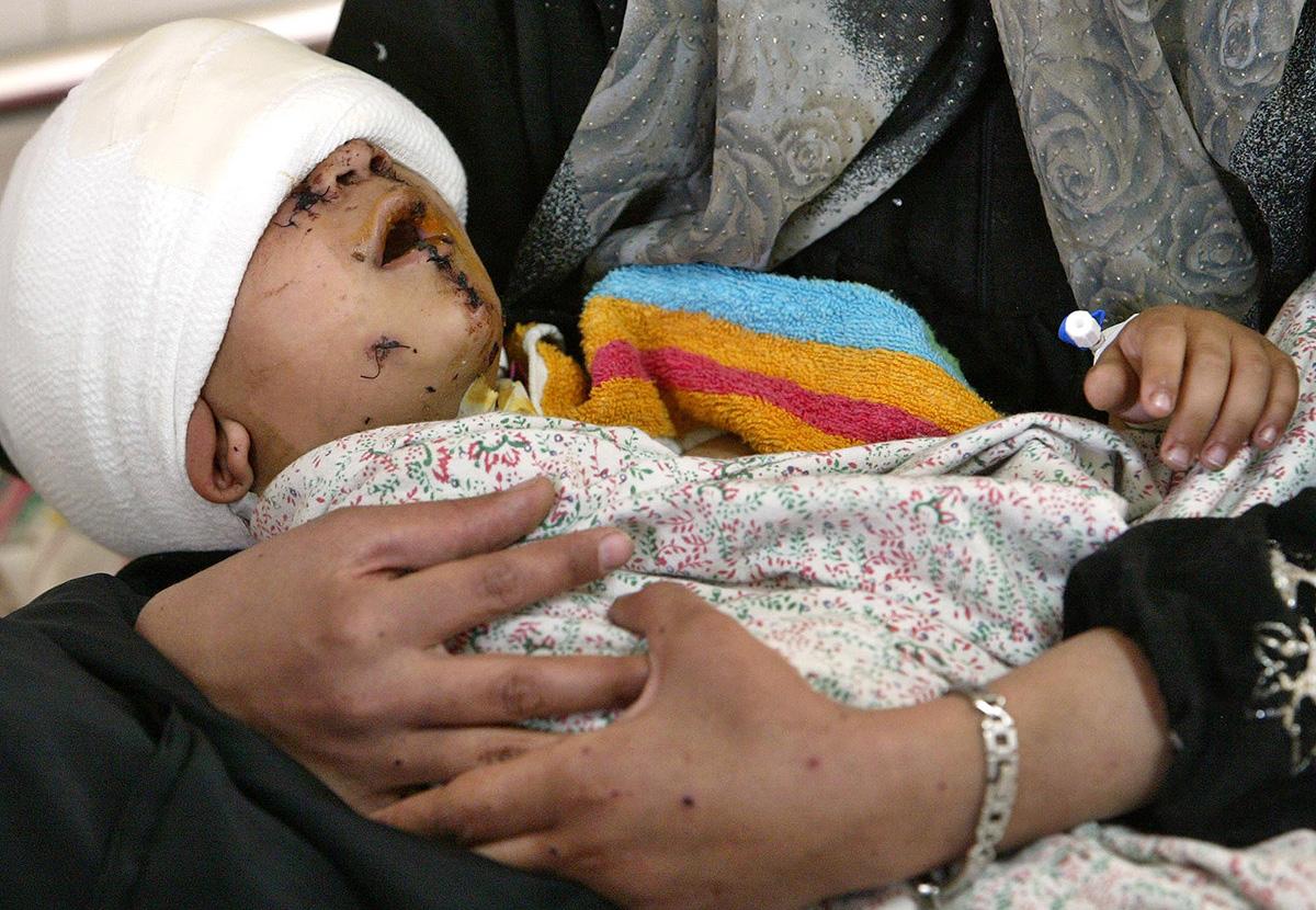 Iraqi child maimed by cluster bomb.