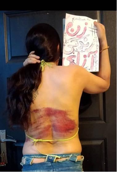 This Iranian woman shared a photograph of just some of her injuries after being whipped 74 times for showing her hair on the street. She is holding a “Woman, Life, Freedom” poster.
