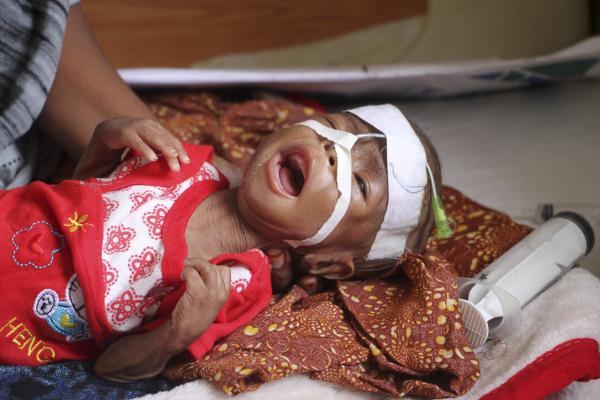 A malnourished child receives treatment in Mogadishu, Somalia, May 14, 2025.