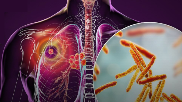 Graphic of tuberculosis in lung and TB cells