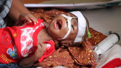 A malnourished child at hospital in Mogadishu, Somalia, May 14, 2025.