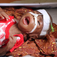 A malnourished child at hospital in Mogadishu, Somalia, May 14, 2025.