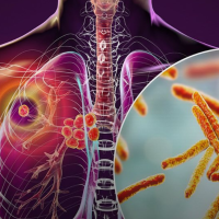 Graphic of tuberculosis in lung and TB cells